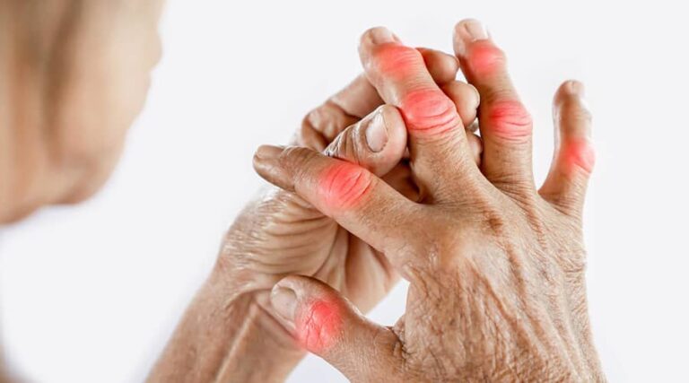Inflammation affecting the hand joints causes the greatest limitation.